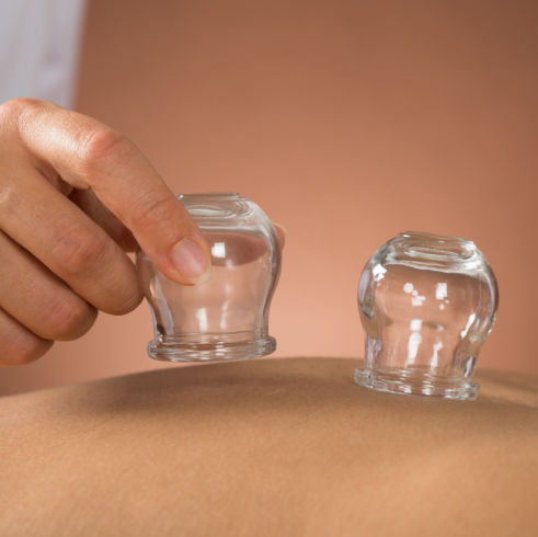 Cupping