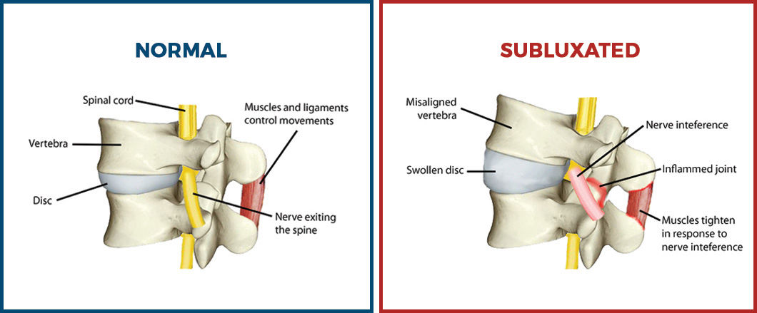 Illustration of subluxation in the spine